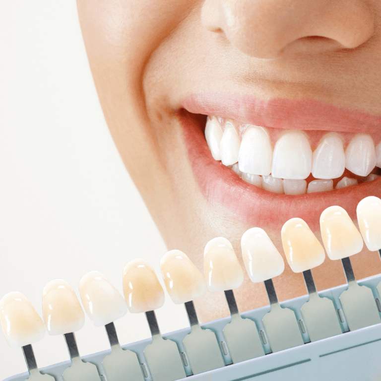 روش های سفید کردن دندان