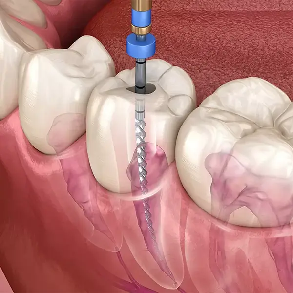 کانال ریشه دندان چیست و چگونه درمان می‌شود؟